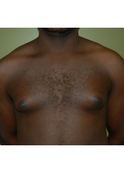 Before Image: Gynecomastia (Male Breast Reduction) - front