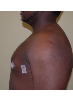 After Image: Gynecomastia (Male Breast Reduction) - other