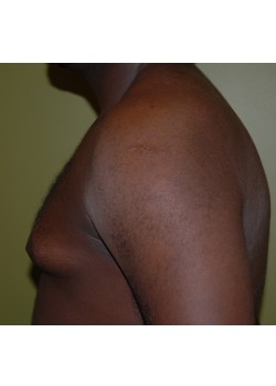 Before Image: Gynecomastia (Male Breast Reduction) - other