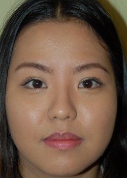 After Image: Asian Double eyelid - front