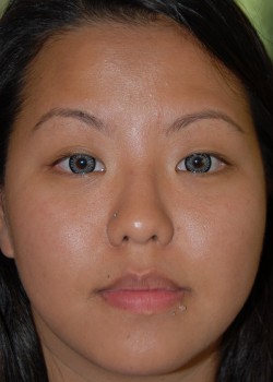 Before Image: Asian Double eyelid - front
