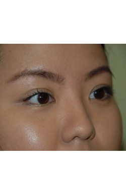After Image: Asian Double eyelid - right-front-oblique