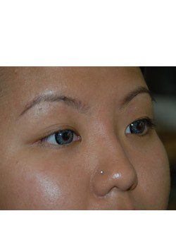Before Image: Asian Double eyelid - right-front-oblique