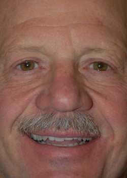 After Image: Upper Eyelid - front