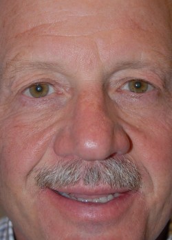 Before Image: Upper Eyelid - front