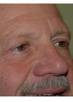 After Image: Upper Eyelid - right-front-oblique