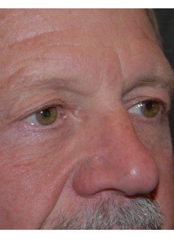 Before Image: Upper Eyelid - right-front-oblique