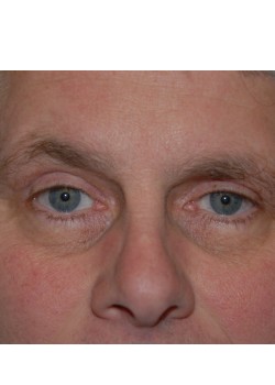 After Image: Upper Eyelid - front