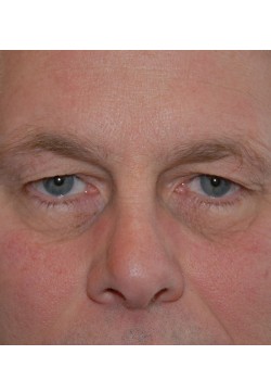 Before Image: Upper Eyelid - front