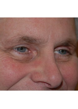 After Image: Upper Eyelid - right-front-oblique