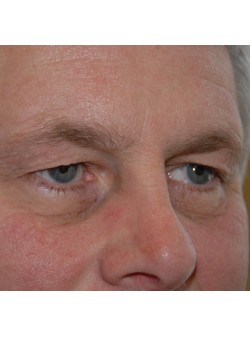 Before Image: Upper Eyelid - right-front-oblique