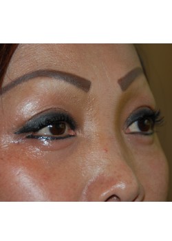 After Image: Asian Double Eyelid - right-front-oblique