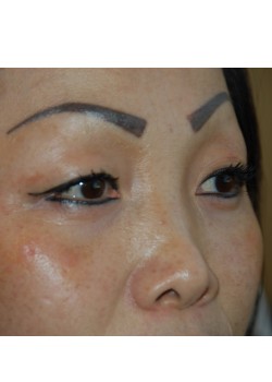 Before Image: Asian Double Eyelid - right-front-oblique