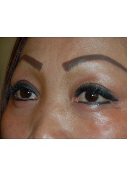 After Image: Asian Double Eyelid - left-front-oblique