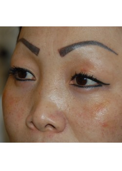 Before Image: Asian Double Eyelid - left-front-oblique
