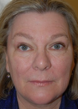 After Image: Upper Eyelid - front