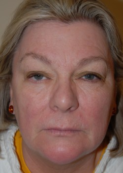 Before Image: Upper Eyelid - front