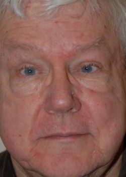 After Image: Upper Eyelid - front