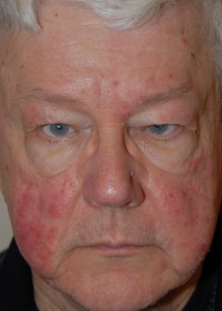 Before Image: Upper Eyelid - front
