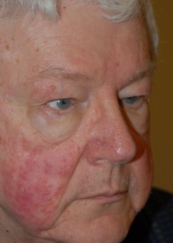 Before Image: Upper Eyelid - right-front-oblique