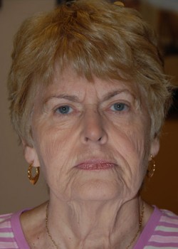 Before Image: Face Lift - front