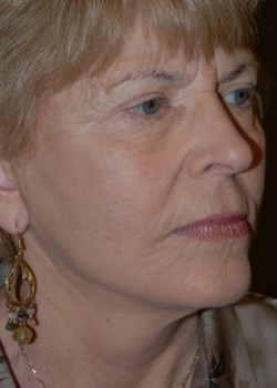 After Image: Face Lift - right-front-oblique