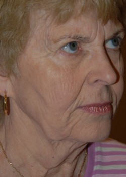 Before Image: Face Lift - right-front-oblique