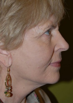 After Image: Face Lift - other