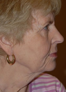 Before Image: Face Lift - other