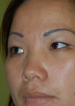 Before Image: Asian Double Eyelid - front
