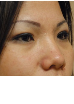 After Image: Asian Double Eyelid - right-front-oblique