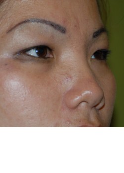 Before Image: Asian Double Eyelid - right-front-oblique