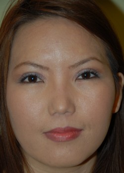 After Image: Asian Double Eyelid - front