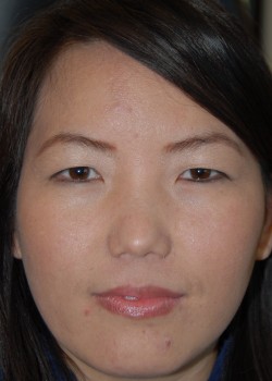 Before Image: Asian Double Eyelid - front