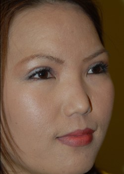 After Image: Asian Double Eyelid - right-front-oblique
