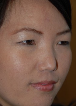 Before Image: Asian Double Eyelid - right-front-oblique