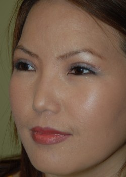 After Image: Asian Double Eyelid - left-front-oblique