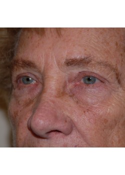 After Image: Upper Eyelid - left-front-oblique