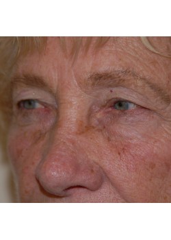 Before Image: Upper Eyelid - left-front-oblique