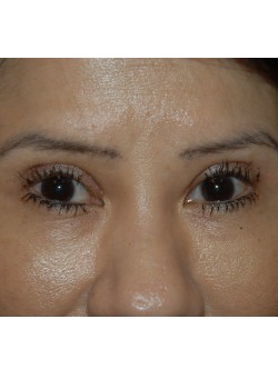 After Image: Asian Double Eyelid - front
