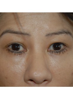 Before Image: Asian Double Eyelid - front