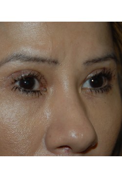 After Image: Asian Double Eyelid - right-front-oblique
