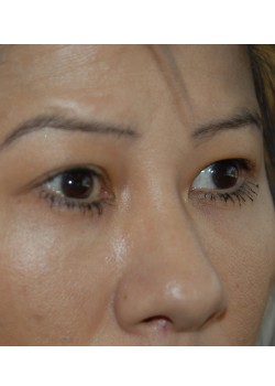 Before Image: Asian Double Eyelid - right-front-oblique