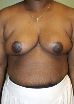 After Image: Breast Reduction - front