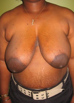 Before Image: Breast Reduction - front