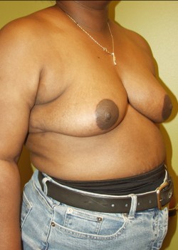 After Image: Breast Reduction - right-front-oblique