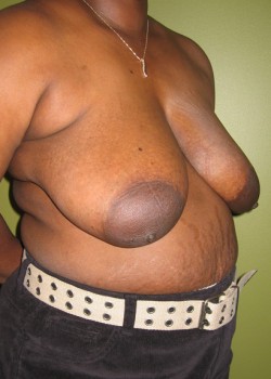 Before Image: Breast Reduction - right-front-oblique