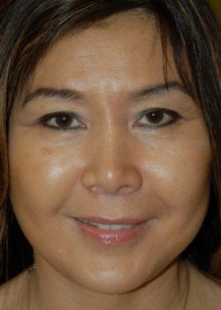 After Image: Face Lift - front