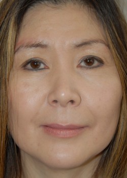 Before Image: Face Lift - front