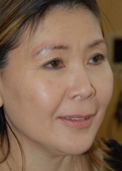 Before Image: Face Lift - right-front-oblique